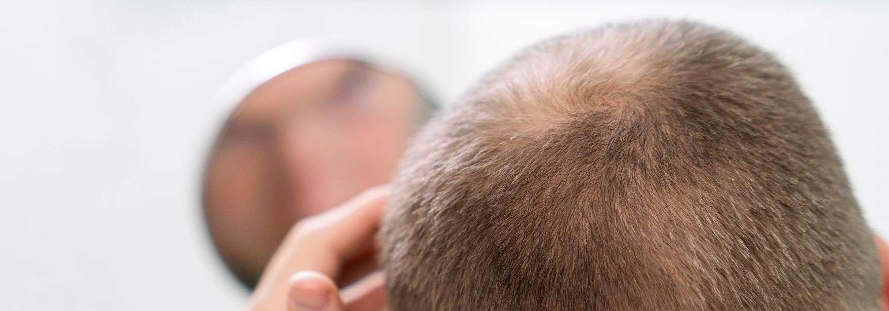 man with balding hair